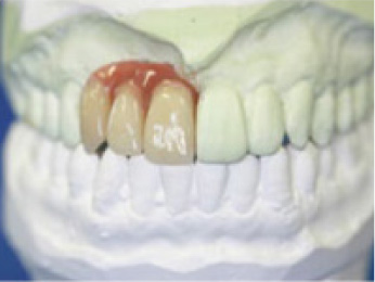 サンプル1　前歯三本