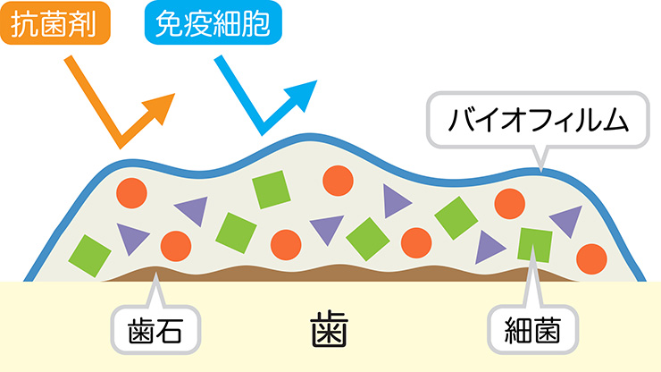 歯周病もバイオフィルムが始まり