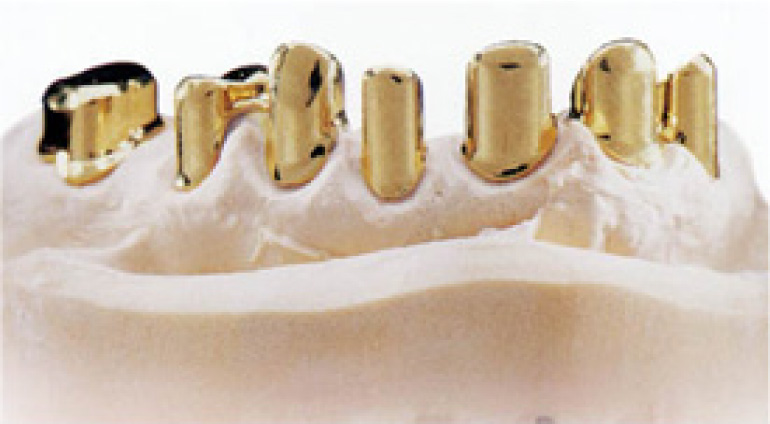 インプラントとは、乳歯、永久歯に継ぐ第3の歯と言われています。