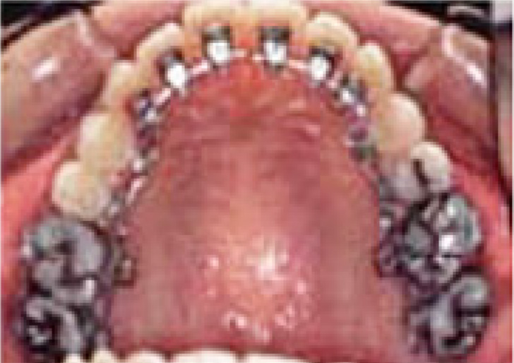 歯の内側につける装置