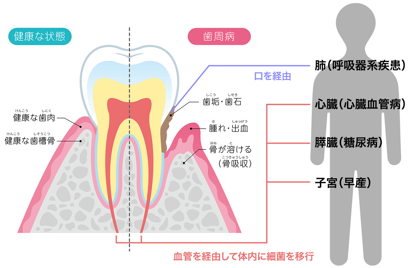 歯周病と全身疾患には深い関わりがあります。