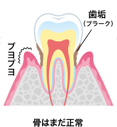 歯周炎