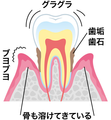 歯周病中等度