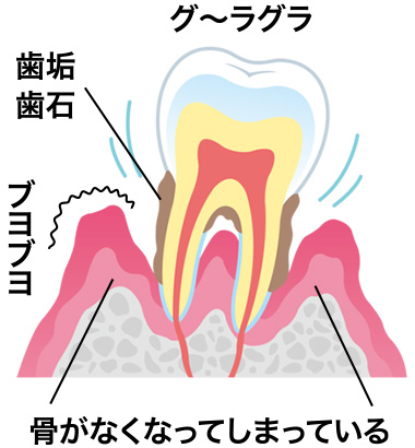 歯周病重度